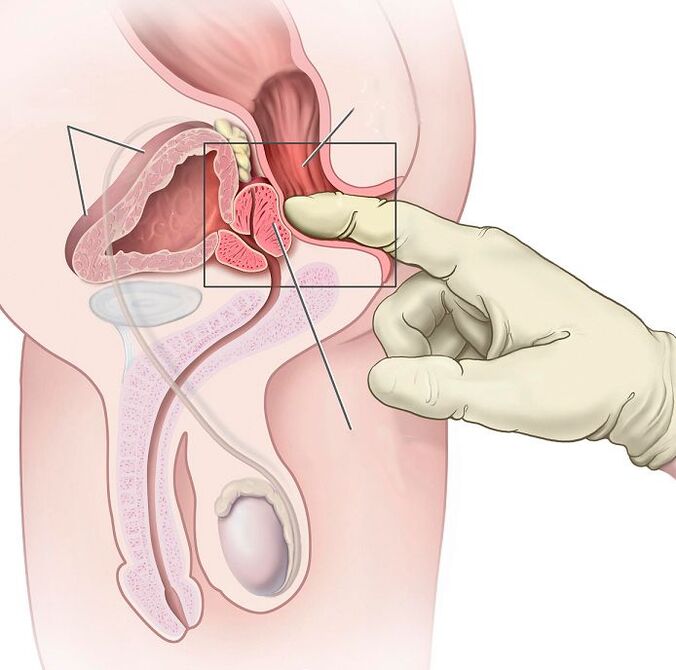 Prostate massage for the treatment of prostatitis.