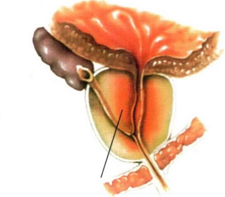 Inflammation of prostate tissue in chronic prostatitis.